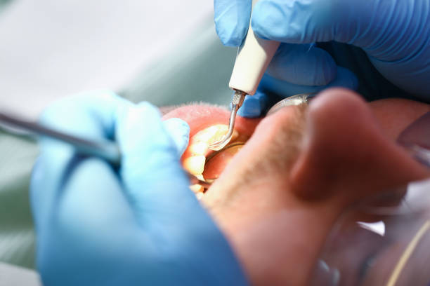 Best Broken or Chipped Tooth Repair in Rome, NY
